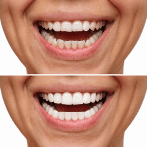 Teeth Whitening Treatments in NYC